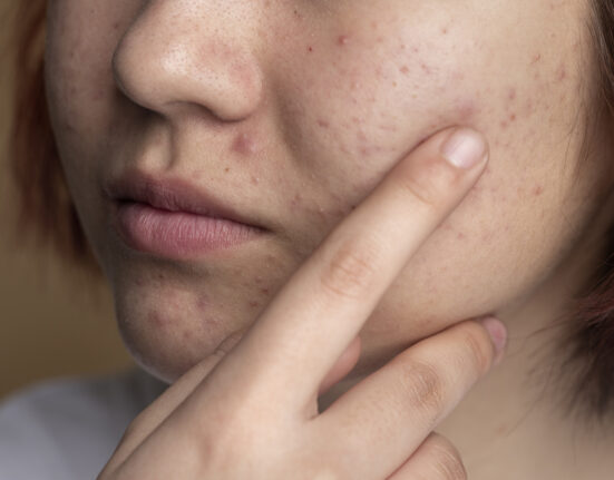 De ce antibioticele nu sunt soluția pentru tratarea acneei. Dar anticoncepționalele funcționează? Ce spun specialiștii