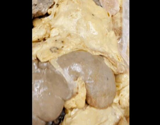 Cum atacă grăsimea viscerală „ascunsă” organele interne: videoclipul viral care șochează internetul. Pericol și pentru persoanele slabe