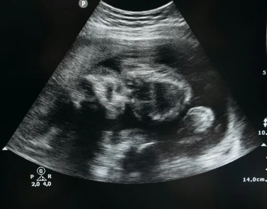 Ce este un lithopedion sau „bebelușul de piatră”? O raritate medicală care fascinează lumea