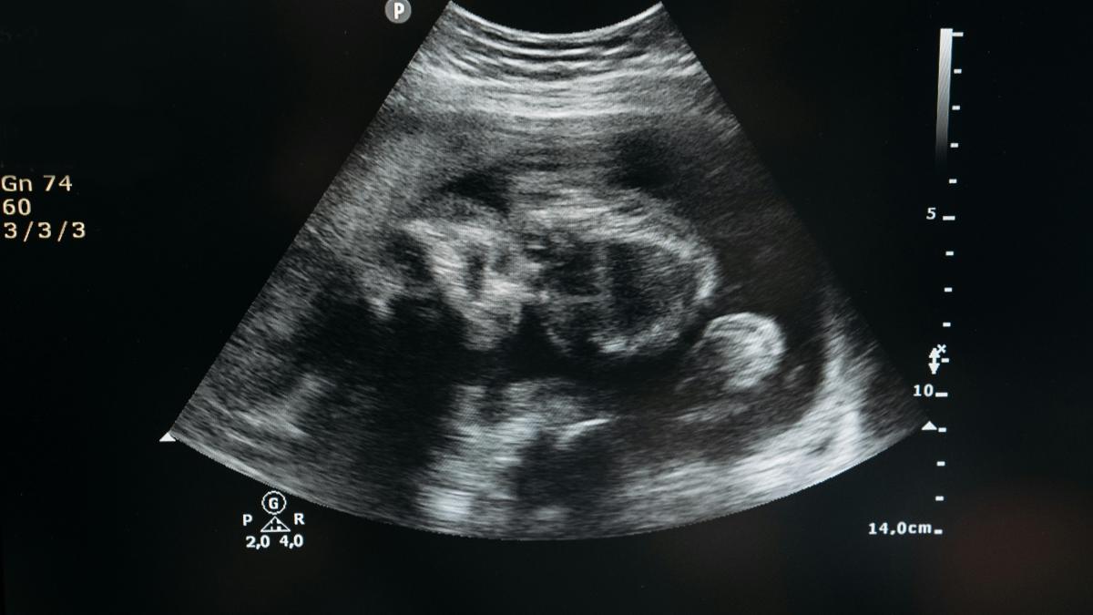 Ce este un lithopedion sau „bebelușul de piatră”? O raritate medicală care fascinează lumea